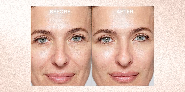 Before and after image of woman's face after using a serum